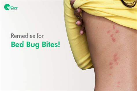 How To Treat Bed Bug Bites Home Remedies at Diane Alejandre blog