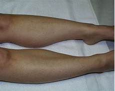 Leg Hair Removal by Laser Hair Removal In Orlando For Legs Laser Centers Of Leg Hair Removal