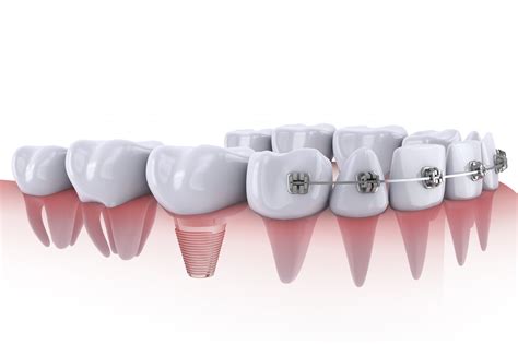 这三种常用补牙材料怎么选？看完这篇文章你就明白！