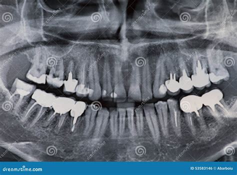 Gold Crown X Ray at Pamala Steven blog