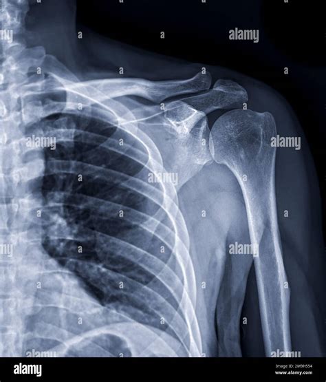 X-ray of Shoulder joint for diagnosis shoulder joint from dislocation ...