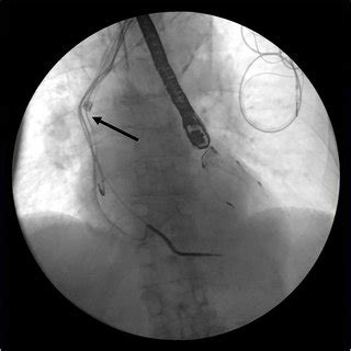 Image result for Laser Lead Extraction Animation Spectranetics