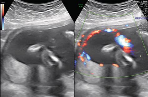 Bildergebnis für velamentous umbilical cord ultrasound