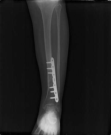 FracAtlas - Dataset Ninja