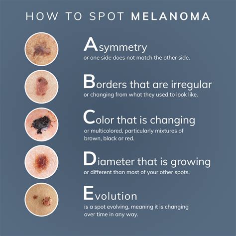 Preventing Melanoma - DermPhysicians of New England