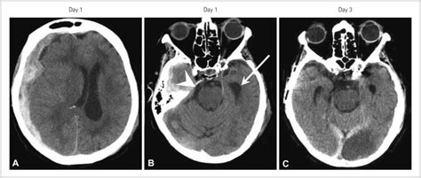 Image result for Contralateral Brain Injury