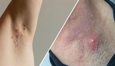 12 Home Remedies To Treat Underarm Pimples - lifeberrys.com