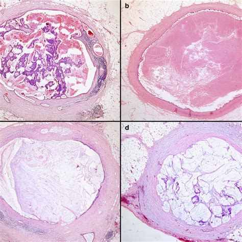 Kuvatulokset haulle pericolonic lymph nodes