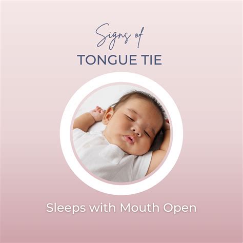 Baby Tongue Tie (Ankyloglossia) — Lactation Consultant Charleston, SC