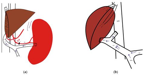 Portal Hemodynamics after Living-Donor Liver Transplantation ...