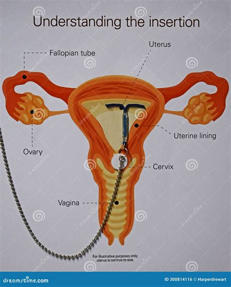IUD Insertion Diagram at Gynecologist S Office Stock Photo - Image of ...