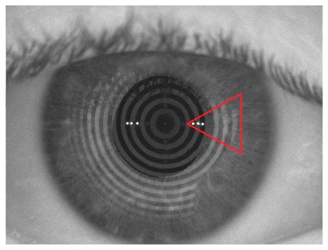 Cysteamine Eye Drops in Hyaluronic Acid Packaged in Innovative Single ...