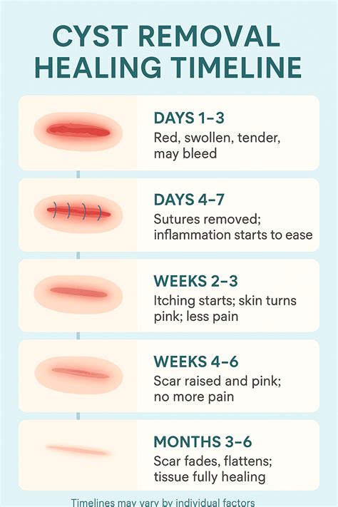 Cyst Removal Recovery Time: Complete Healing Guide | Aventus Clinic