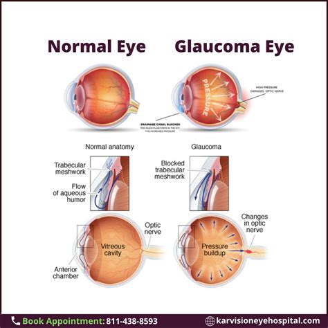 Primary Symptoms Of Open Angle Glaucoma To Watch For