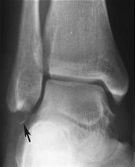 Chronic Ankle Pain And Inflammation Following Atfl Rupture