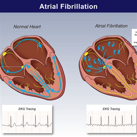 Atrial Fibrillation 的图像结果