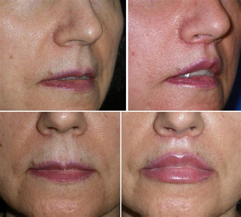 Lip Lift Richmond VA | Lip Implants | Injectable Fillers