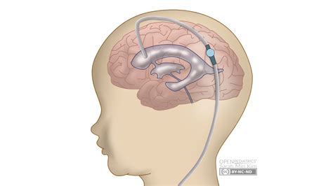 Ventriculoperitoneal shunt