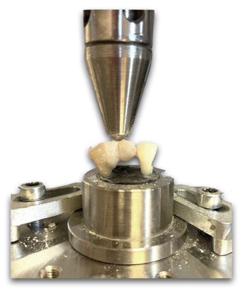 Fatigue Resistance of Dissected Lower First Molars Restored with Direct ...