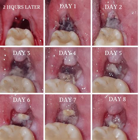 Wisdom Tooth Removal Recovery