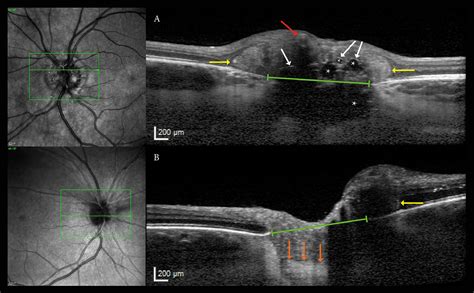 Optic Nerve Head Anatomy and Vascular Risk Factors in Patients With Optic Disc Drusen Associated ...