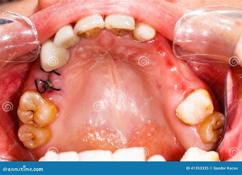 Image result for Stitches After Tooth Extraction