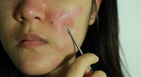 Are blackhead extractors safe to be used at home? | TheHealthSite.com