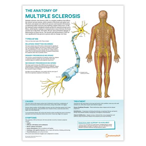 The Anatomy of Multiple Sclerosis Chart / Poster - | AnatomyStuff