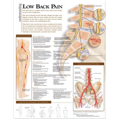 Low Back Pain Chart (52x70cm) With Special Lamination - back pain chart