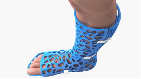 3D-Printed Orthopedic Casts on Limbs Collection 3D Model $99 - .3ds ...