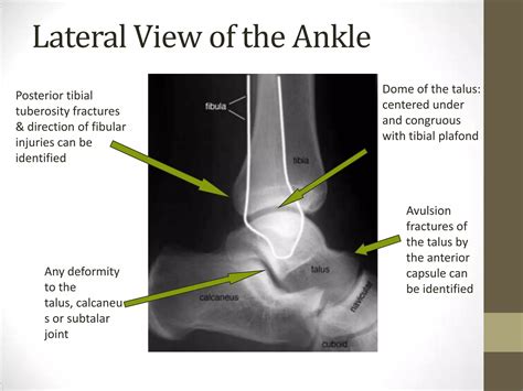 Ankle joint radiography | PPTX