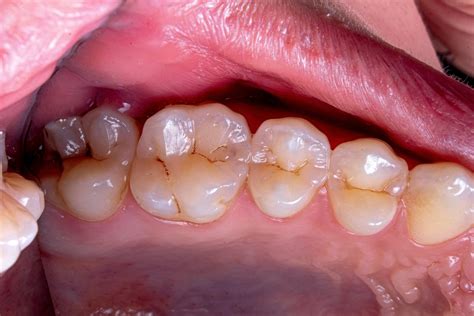 Dental Plaque Removal: How to Prevent and Treat Plaque Buildup