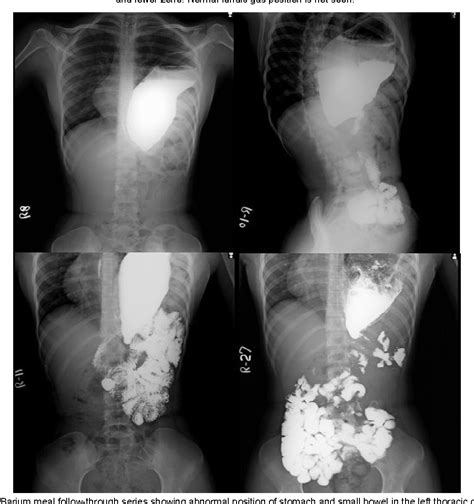 Diaphragmatic Hernia In Adults