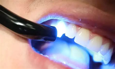 Resin-based composites containing finer fillers best maintain ...