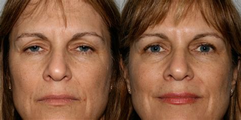 BEFORE AFTER BLEPHAROPLASTY SURGERY - before after