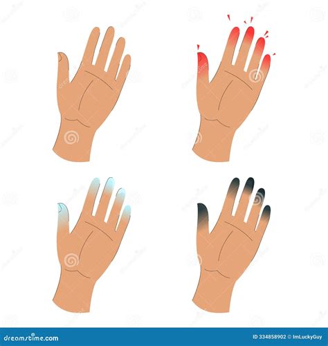 Frostbite Stages Infographic Vector Isolated Stock Illustration - Illustration of heat, doctor ...