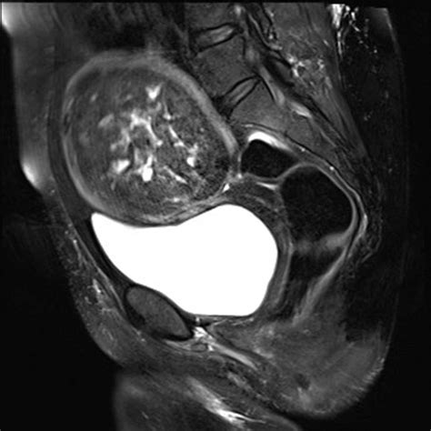 Uterine Fibroid - Body MR Radiology Case Studies - CTisus CT Scanning