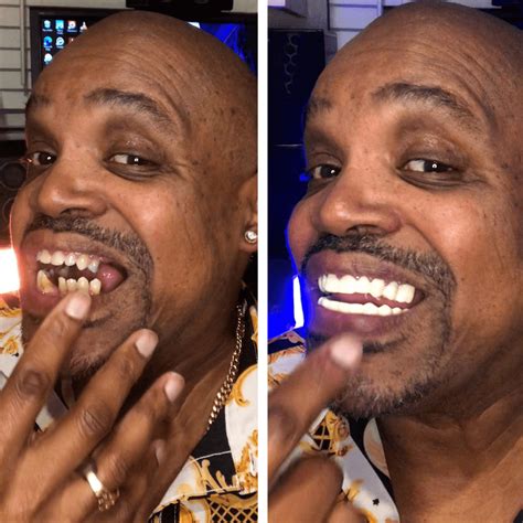 Pop On Veneers Reviews