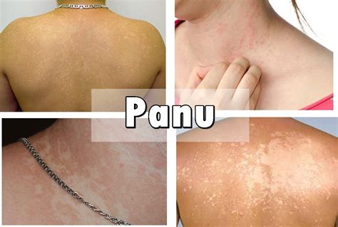 cara menghilangkan panu dengan minyak zaitun