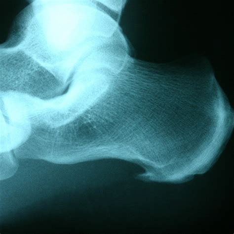 Heel Spur X Ray