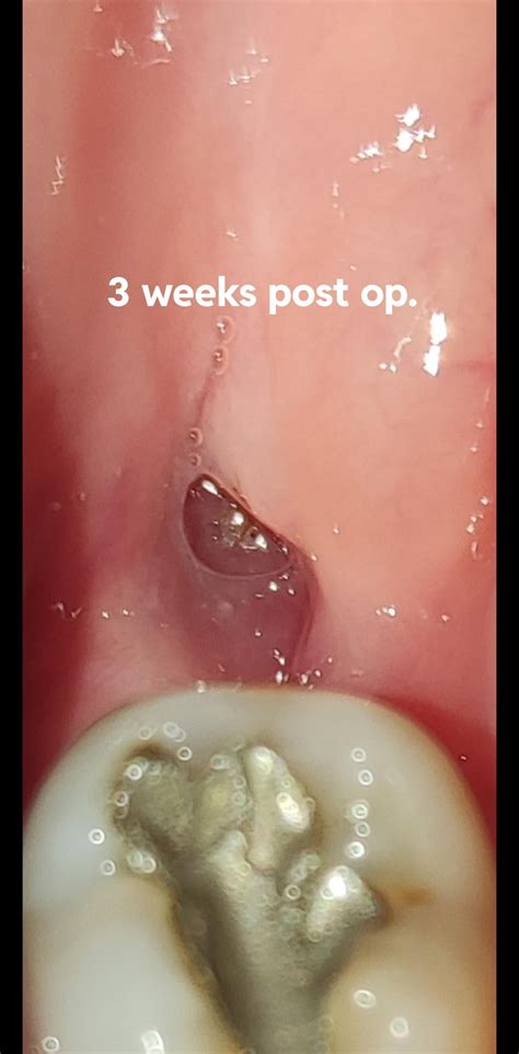 If you think you have a dry socket, you don't. : r/wisdomteeth