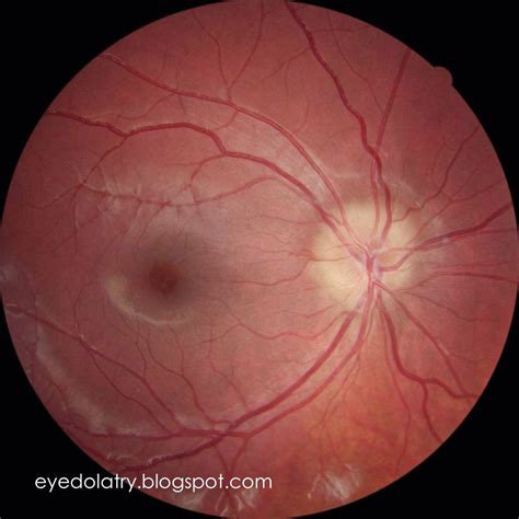 Differentiating True Optic Nerve Edema - Eyedolatry