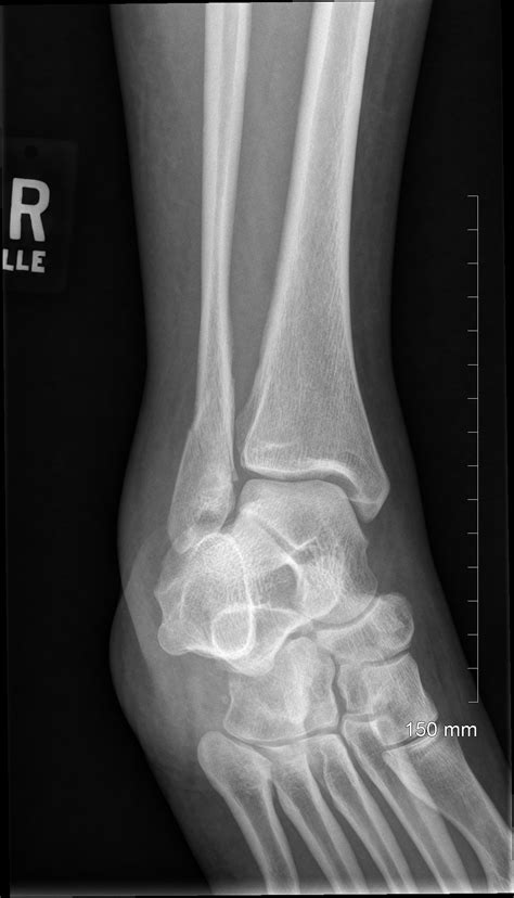Xray Broken Ankle