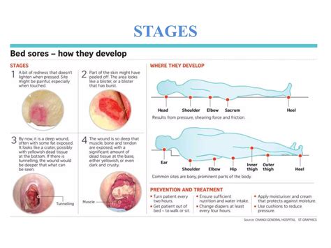 Pressure sore or bed sore or decubitus ulcer ppt | PPTX