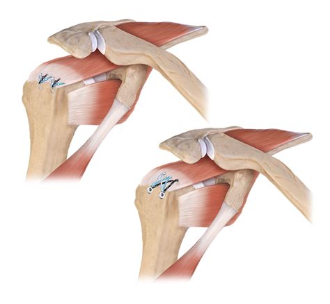 Image result for Single Row Rotator Cuff Repair