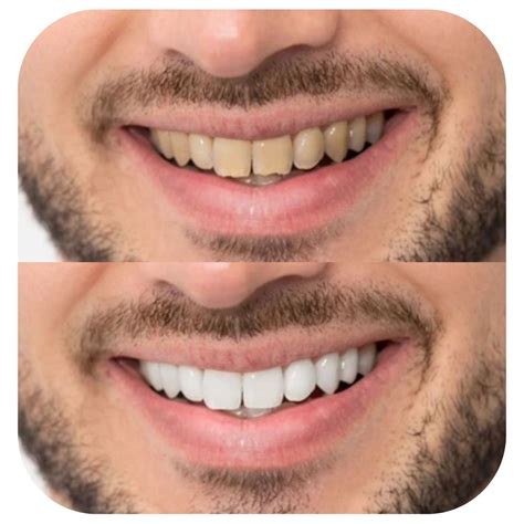 Fang Teeth Whitening V1 – Fang Oral Care