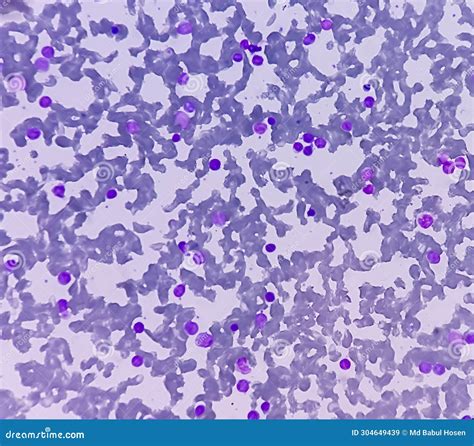 Leukemia. Blood Cells, Blast Cells And Immature Leukocytic Cells In ...