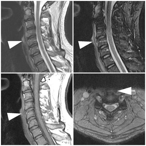 Anterior Longitudinal Ligament