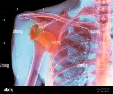 Collarbone x ray hi-res stock photography and images - Alamy