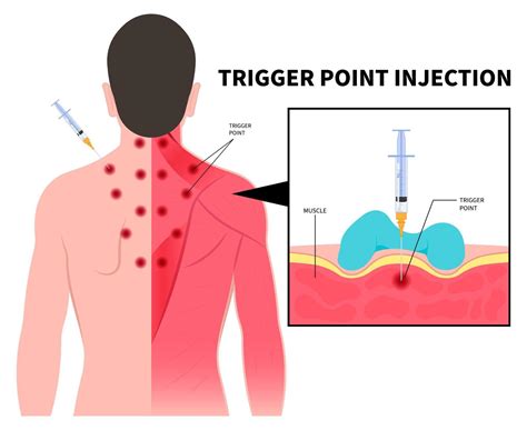 Pain Specialist Singapore | Trigger Injections